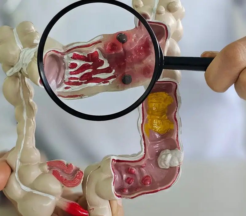 Doença inflamatória intestinal dispara e cresce 5 vezes no Brasil