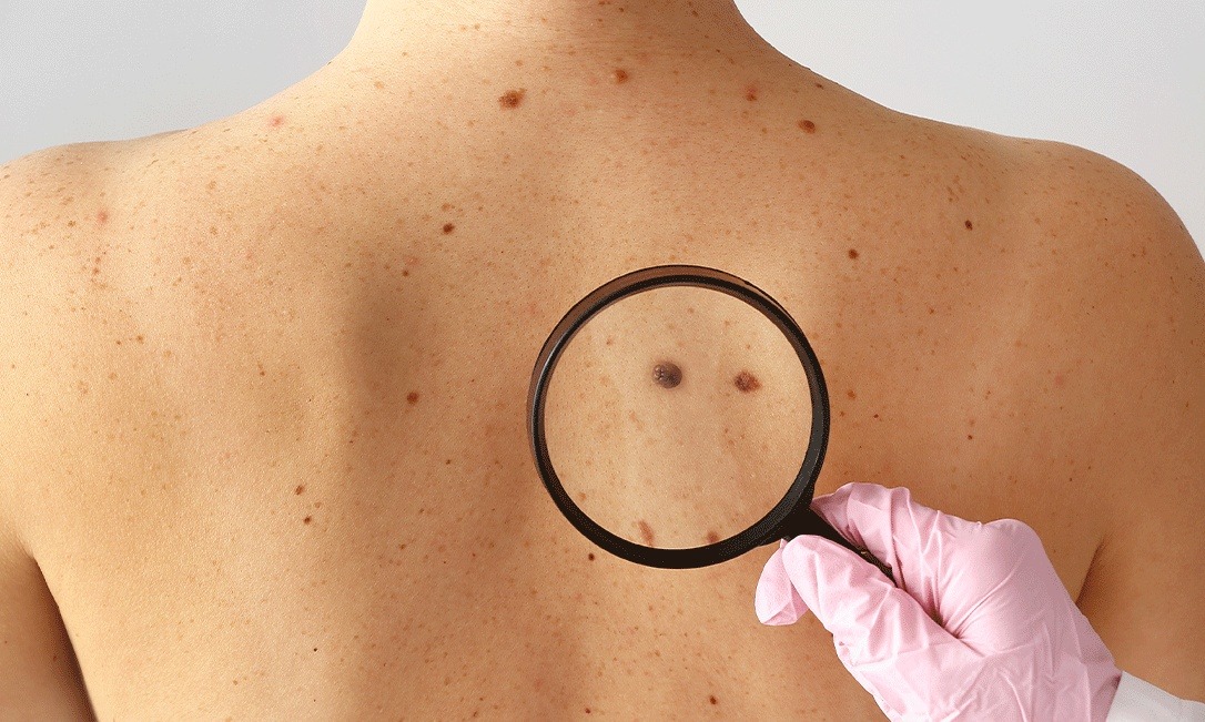 Câncer: estudo alerta para riscos de melanoma fora da pele