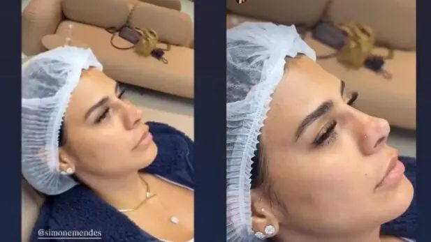 Simone Mendes nega rinoplastia e revela procedimento no nariz