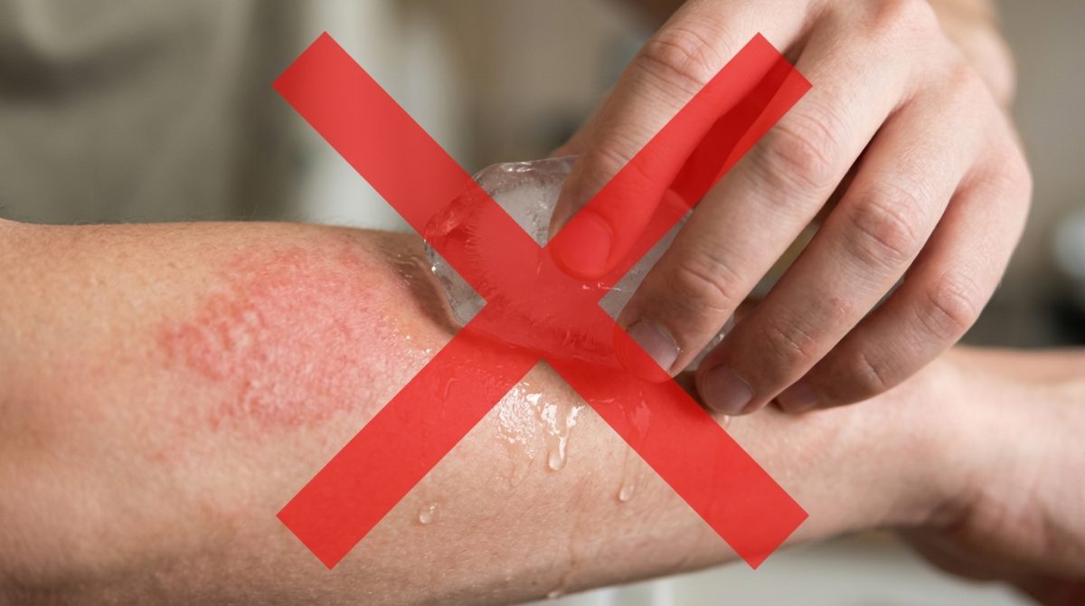Colocar gelo diretamente sobre uma queimadura parece a maneira mais rápida de aliviar a dor, mas pode agravar a lesão: autoridades australianas recomendam água corrente fresca por pelo menos 20 minutos