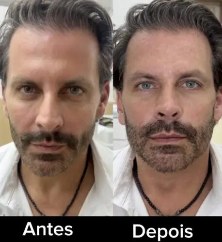 Henri Castelli muda o visual após nova harmonização facial